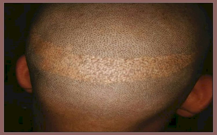 إزالة الشعر المفرط في طريقة استخراج وحدة المسام