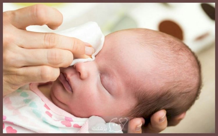 افرازات العين لدى الأطفال الرضع