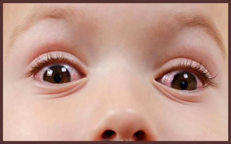 أسباب الافرازات في العين لدى الطفل